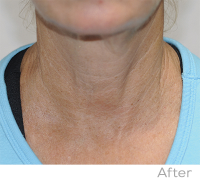 Exilis After Photo