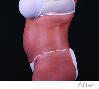 Exilis After Photo