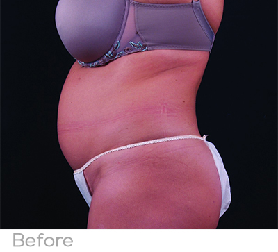 Exilis Before Photo