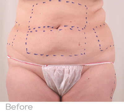 Exilis Before Photo