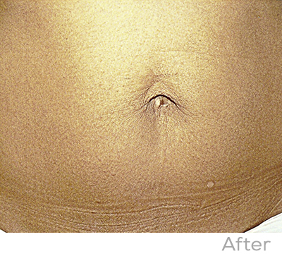 Exilis After Photo