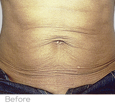 Exilis Before Photo