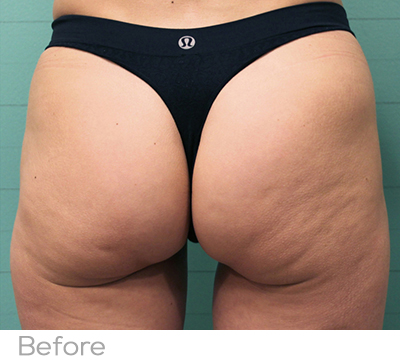 Exilis Before Photo