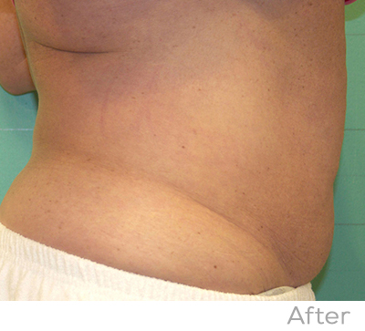 Exilis After Photo