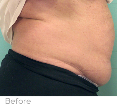 Exilis Before Photo