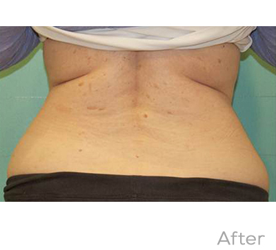 Exilis After Photo