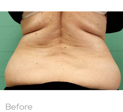 Exilis Before Photo