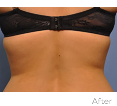 Exilis After Photo