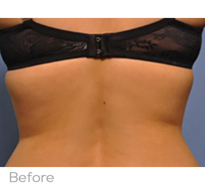 Exilis Before Photo