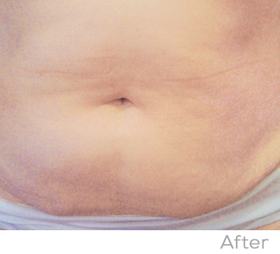 Exilis After Photo