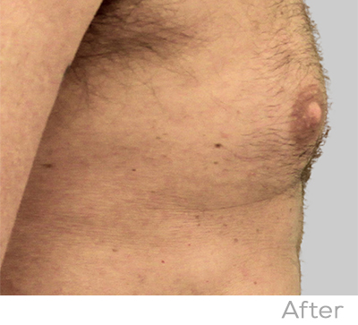 Exilis After Photo