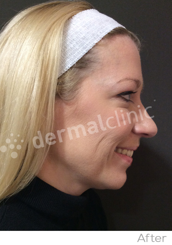 Wrinkle Reduction Treatment After Photo