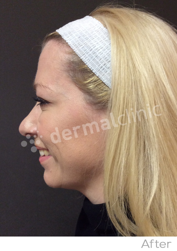 Wrinkle Reduction Treatment After Photo