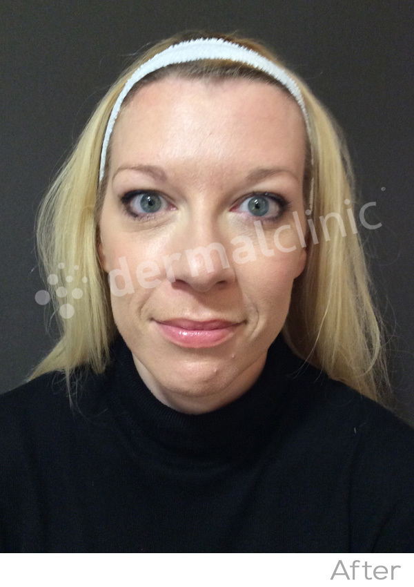 Wrinkle Reduction Treatment After Photo