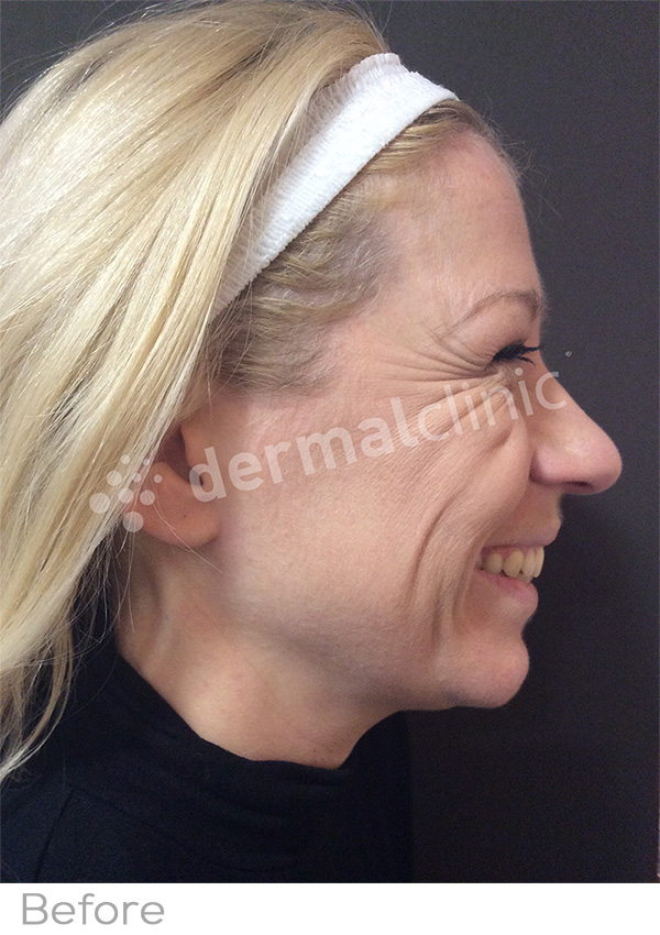 Wrinkle Reduction Treatment Before Photo