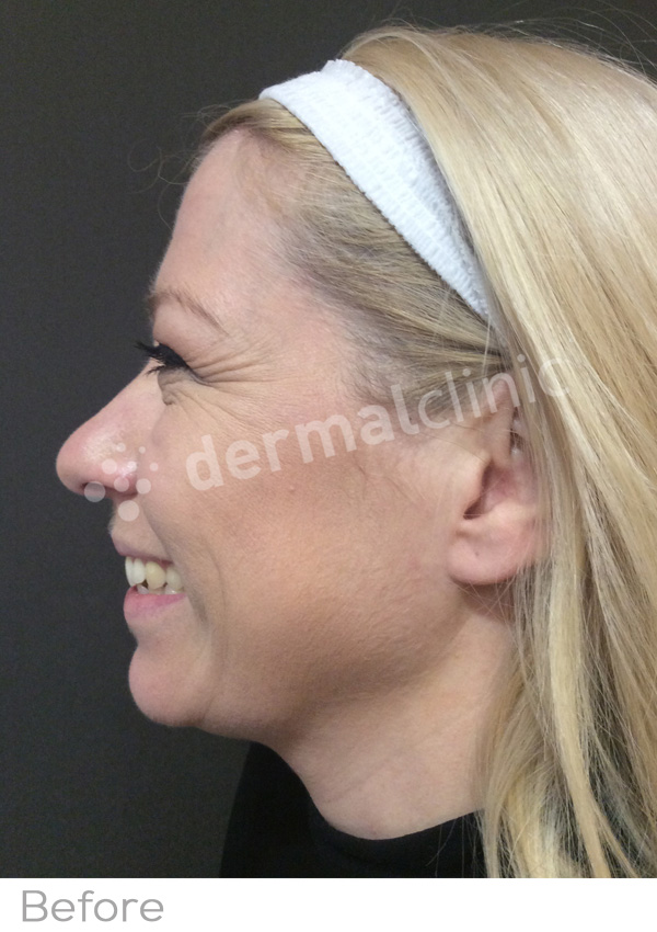 Wrinkle Reduction Treatment Before Photo