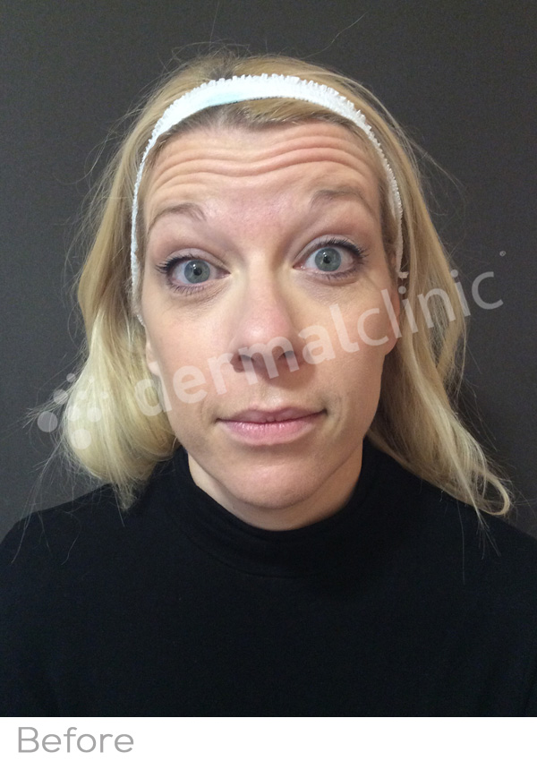 Wrinkle Reduction Treatment Before Photo
