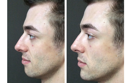 Dermal Fillers