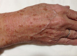 Laser Skin Treatments