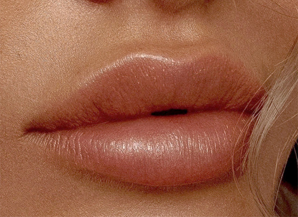 Lip Fillers