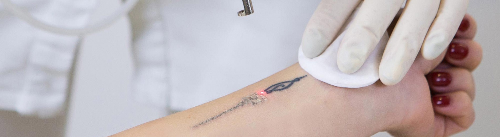 laser-tattoo-removal