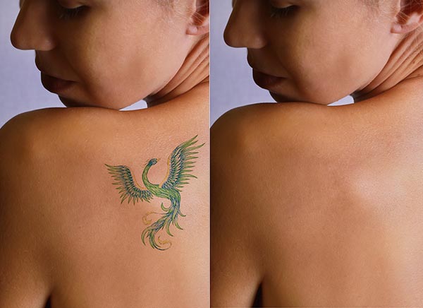 Laser Tattoo Removal